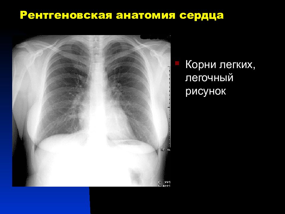 Легочный рисунок на рентгенограммах обусловлен теневым отображением