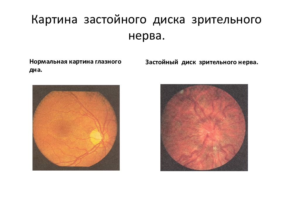 Картина нормального глазного дна