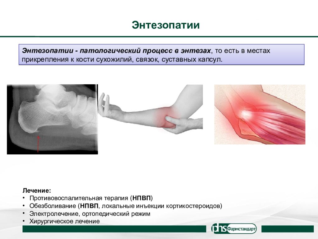 Энтезопатия связок коленного сустава