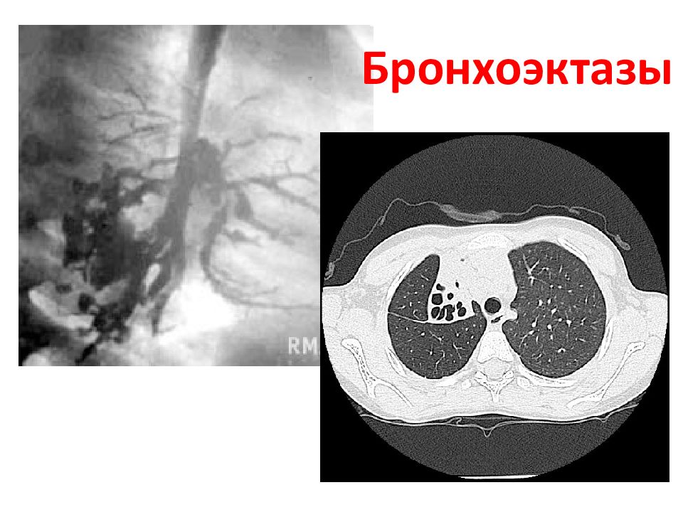 Бронхоэктазы. Мешотчатые бронхоэктазы кт. Бронхоэктазы с воспалением кт. Цилиндрические бронхоэктазы на кт. Кт картина бронхоэктазов.