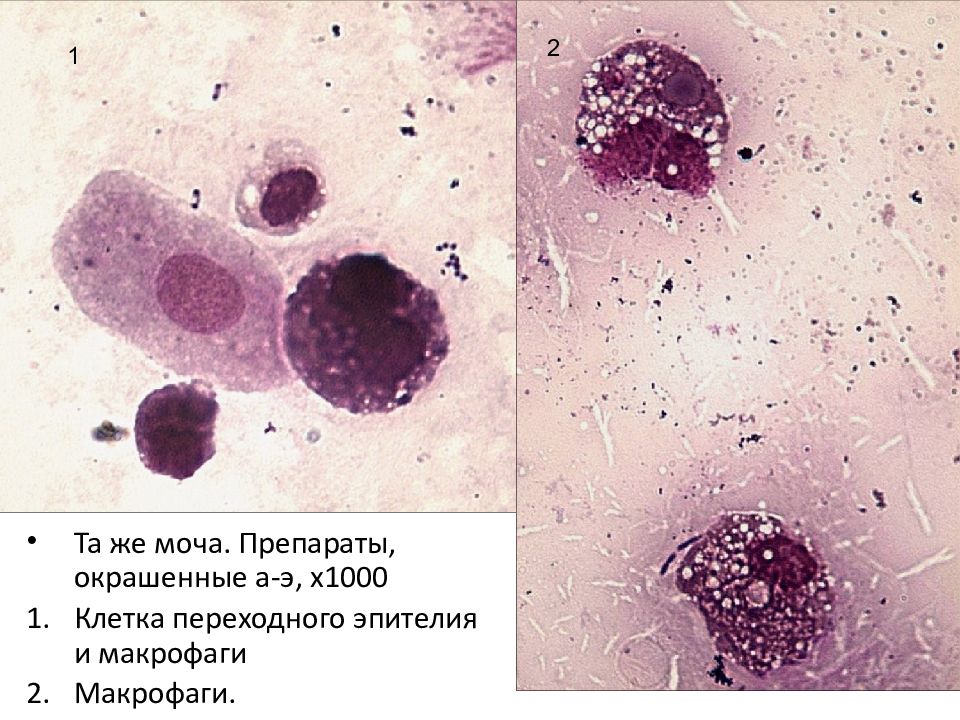 Макрофаги 1 2. Альвеолярные макрофаги. Макрофаги гистология. Пенистые макрофаги гистология. Фагоциты микроскопия.