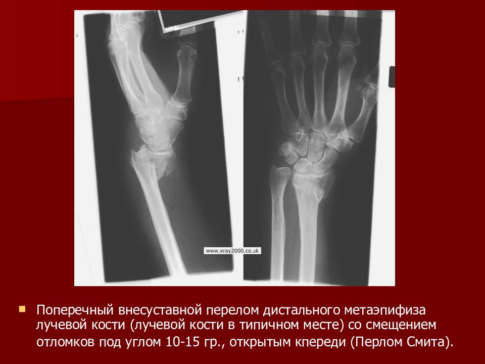 Оскольчатый перелом дистального метаэпифиза лучевой кости. Перелом дистального эпифиза лучевой кости рентген. Перелом дистального метаэпифиза шиловидного отростка лучевой кости. Краевой перелом дистального эпифиза лучевой кости.