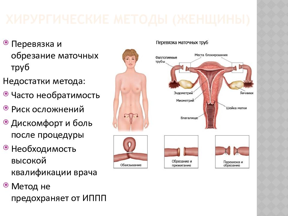 Перевязка маточных труб картинки