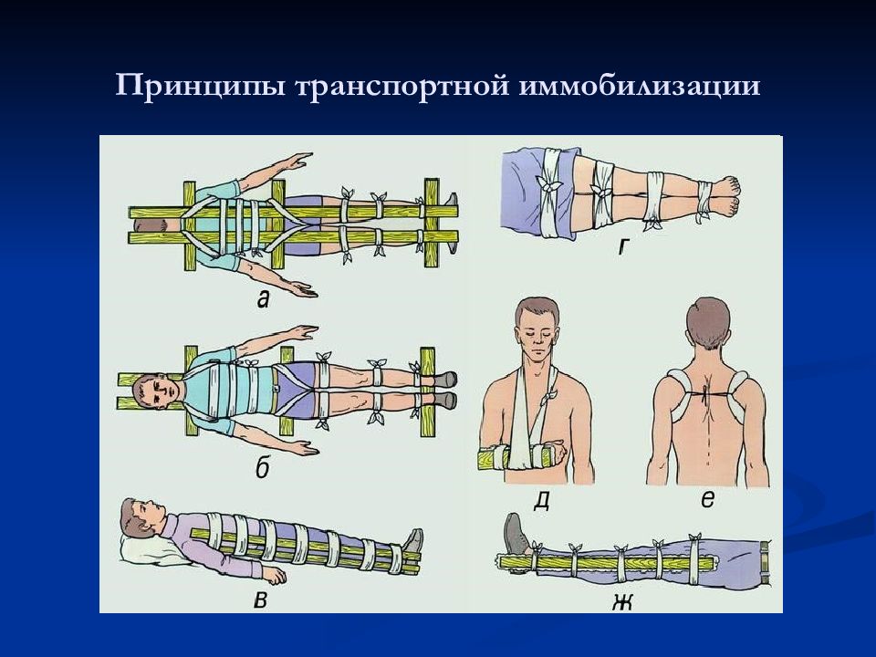 Правила проведения иммобилизации. Иммобилизация конечности. Принципы транспортной иммобилизации. Принципы иммобилизации при переломах. Понятие об иммобилизации.