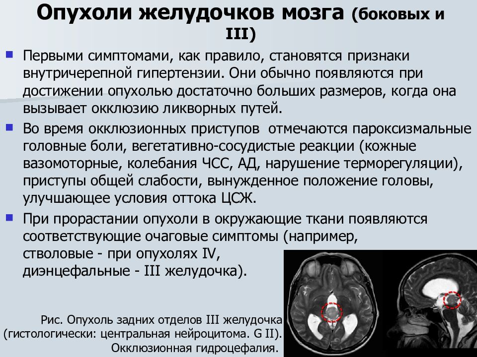 Диагноз опухоли головного. Опухоль головного мозга симптомы. Локализация опухолей головного мозга. Опухоль желудочка головного мозга. Опухоли головного мозга сим.