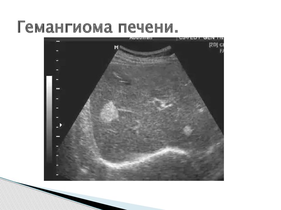 Гемангиома печени лечение у женщин препараты схема лечения взрослым