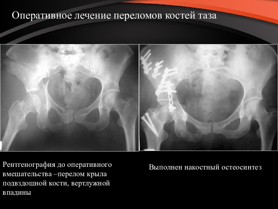 Картинка перелом костей таза