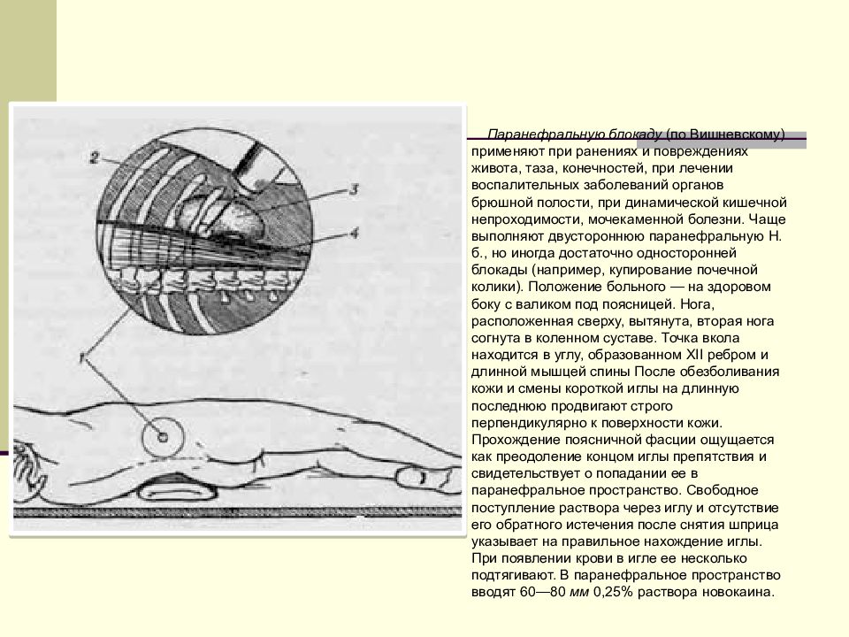 Концентрация новокаина для паранефральной блокады. Место введения иглы при паранефральной блокаде. Схема поясничной паранефральной новокаиновой блокады. Поясничная паранефральная новокаиновая блокада. Паранефральная блокада топографическая анатомия.