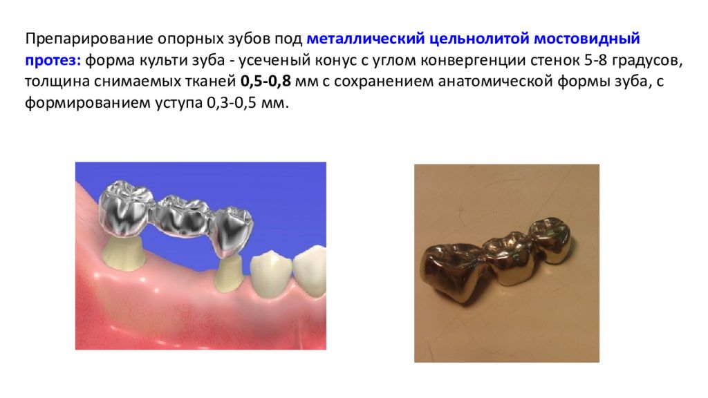 Изготовление мостовидных протезов презентация