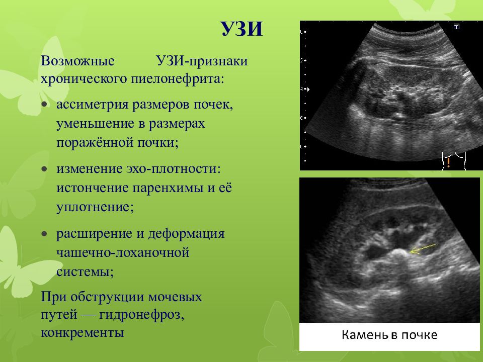 Узи картина мочекаменной болезни