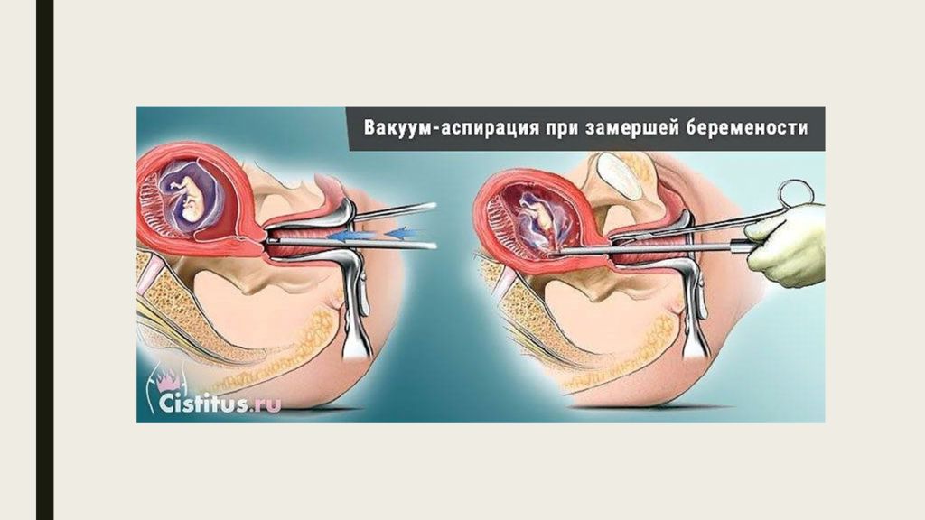 Замершая беременность презентация