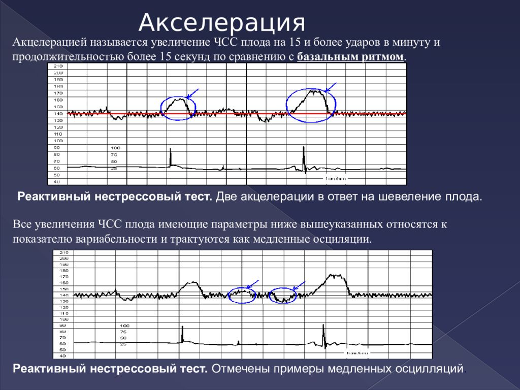 Осцилляция ктг