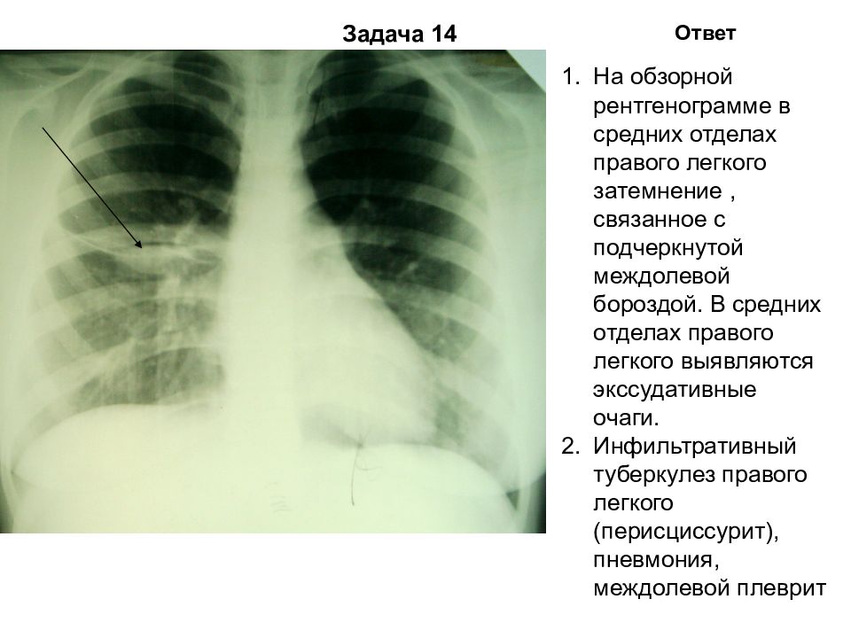 Перисциссурит рентген картина