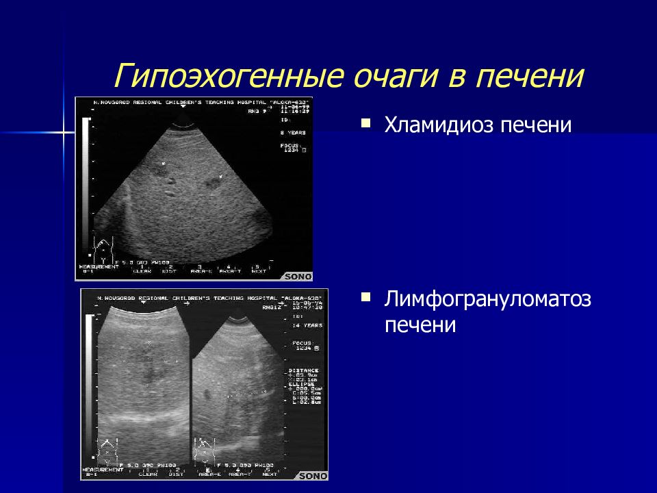 Очаговые заболевания печени презентация