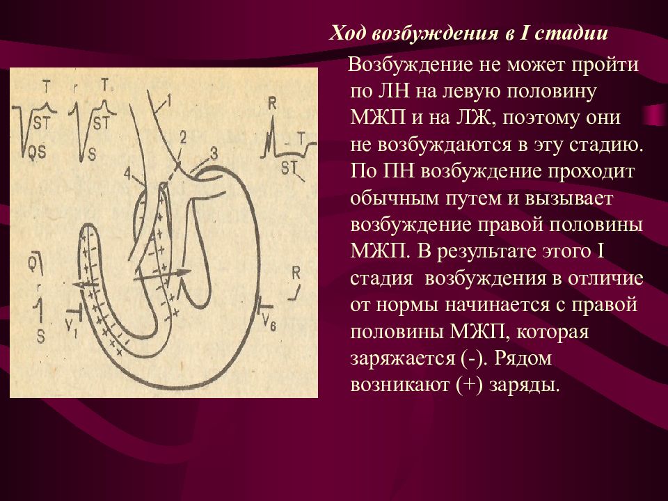 Гиса. Ход возбуждения в миокарде. Прохождение возбуждения по межжелудочковой перегородке. Ход возбуждения при блокаде левой ножки пучка Гиса. Возбуждение межжелудочковой перегородки на ЭКГ.