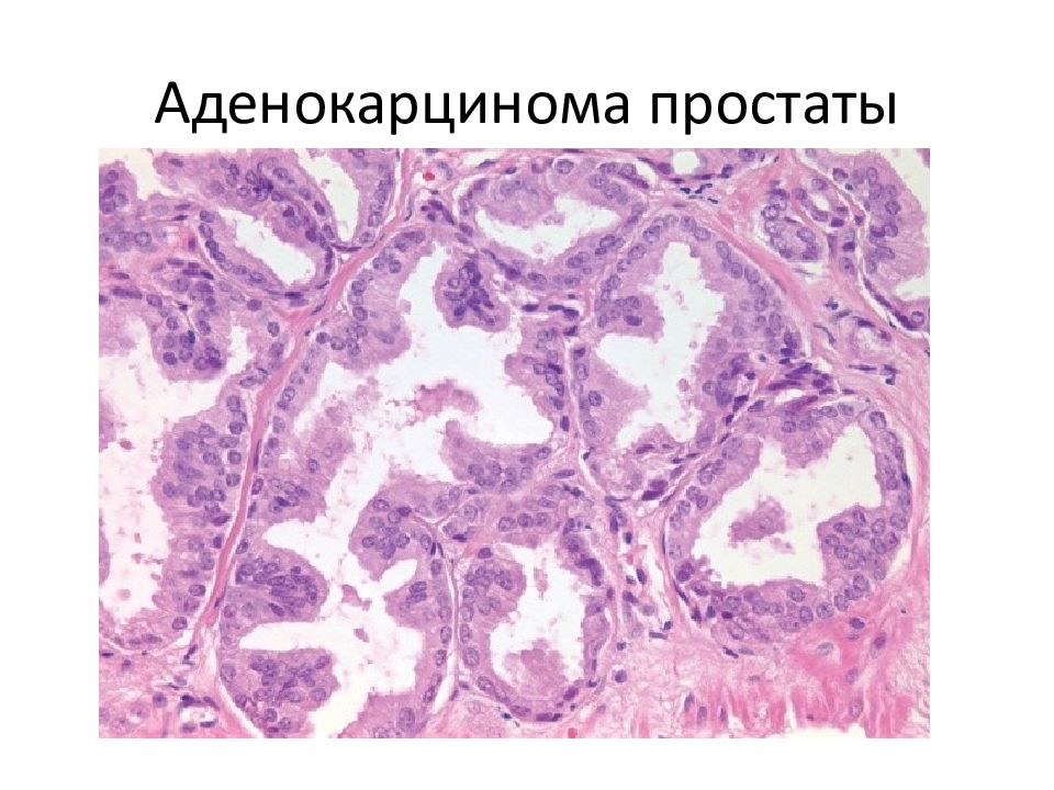 Лечение ацинарной аденокарциномы предстательной