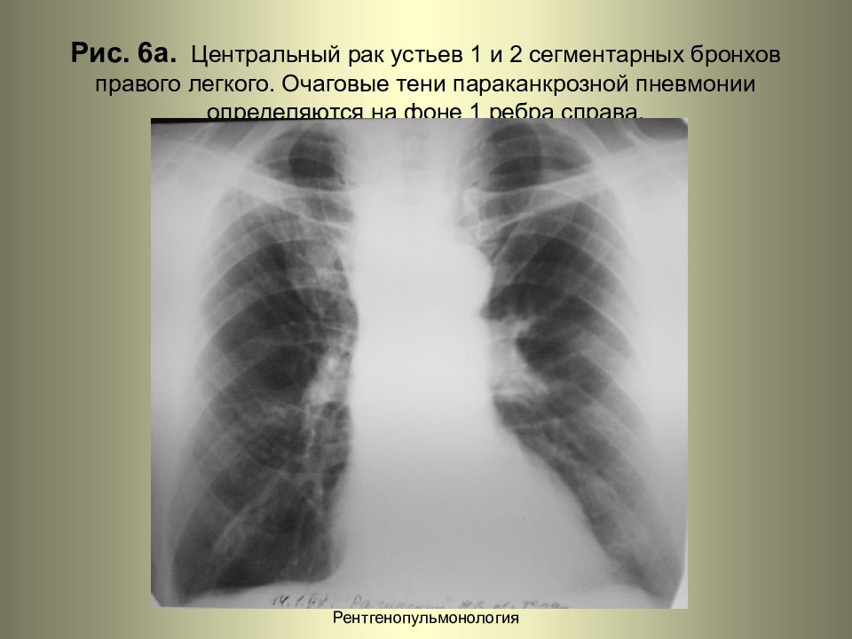 Центральный рак легкого презентация