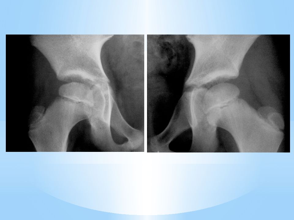 Остеохондропатия бедренной. Болезнь Легга Кальве Пертеса. Остеохондропатия Пертеса. Остеохондропатия головки бедра – болезнь Легга-Кальве-Пертеса..