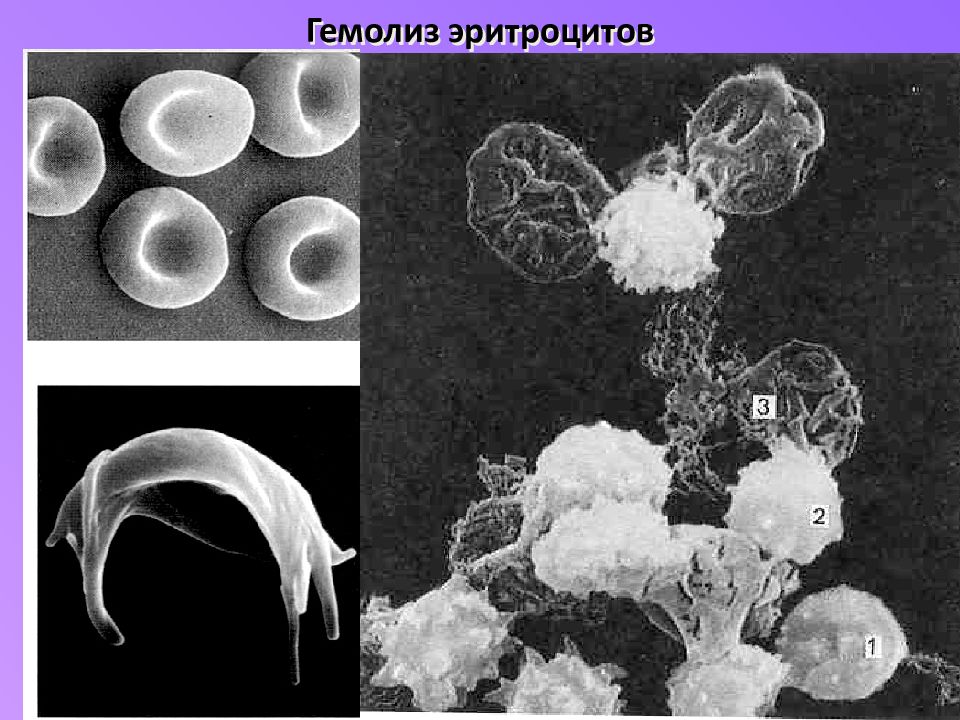 Гемолиз эритроцитов. Разрушенные эритроциты. Гемолиз эритроцитов в воде. Гемолиз эритроцитов картинки.