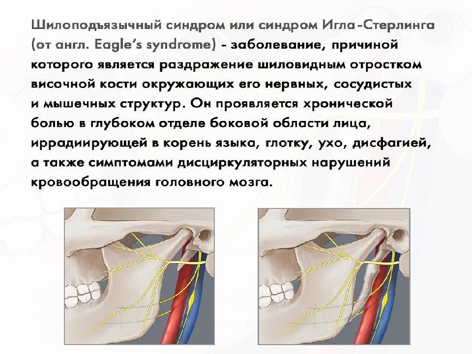 Шилоподъязычный синдром фото