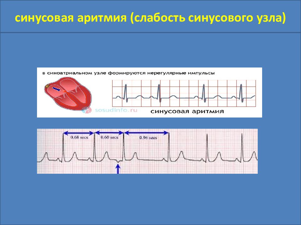 Аритмии презентация факультетская терапия