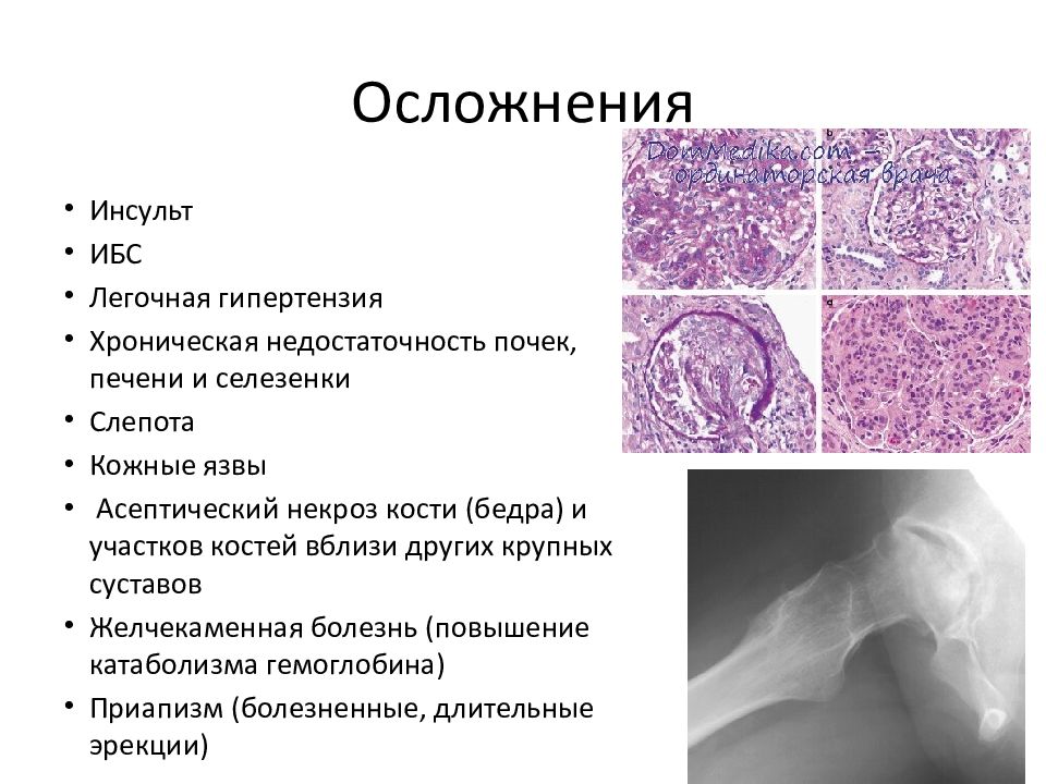 Серповидноклеточная анемия презентация