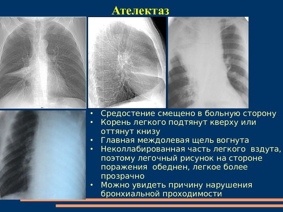 Ателектаз легкого