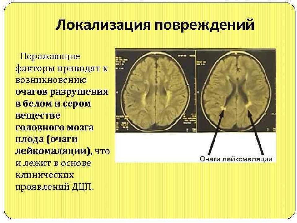 Дцп головного мозга