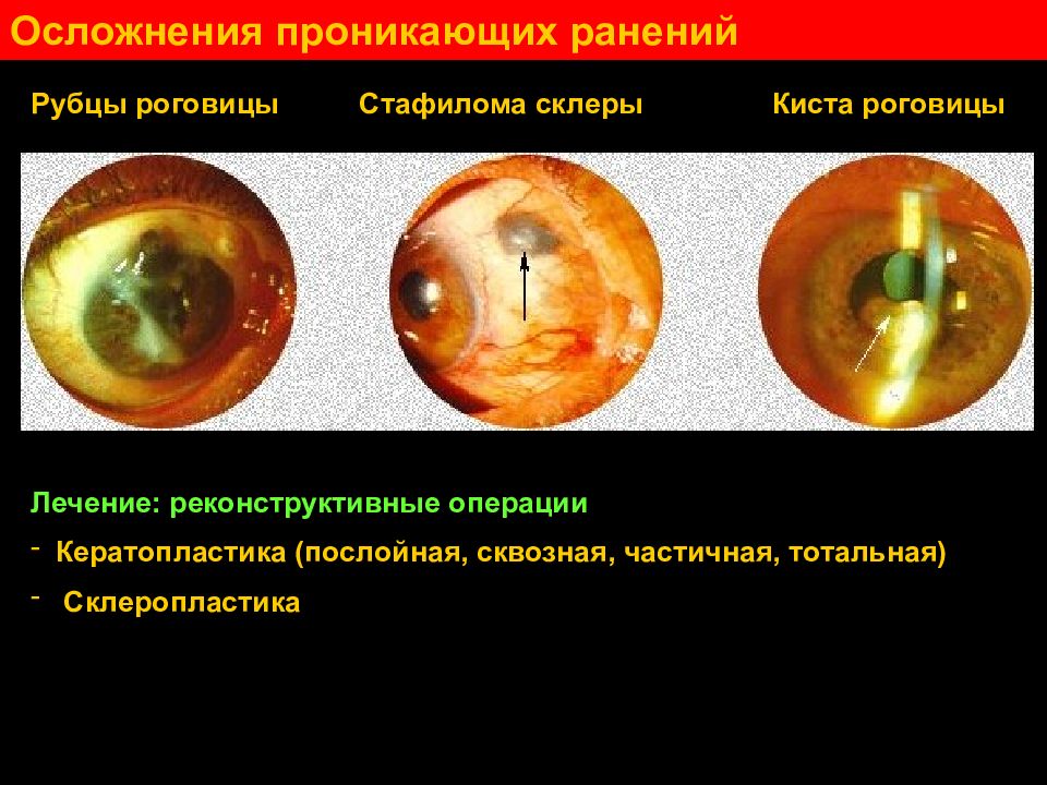 Кератопластика Цена К31