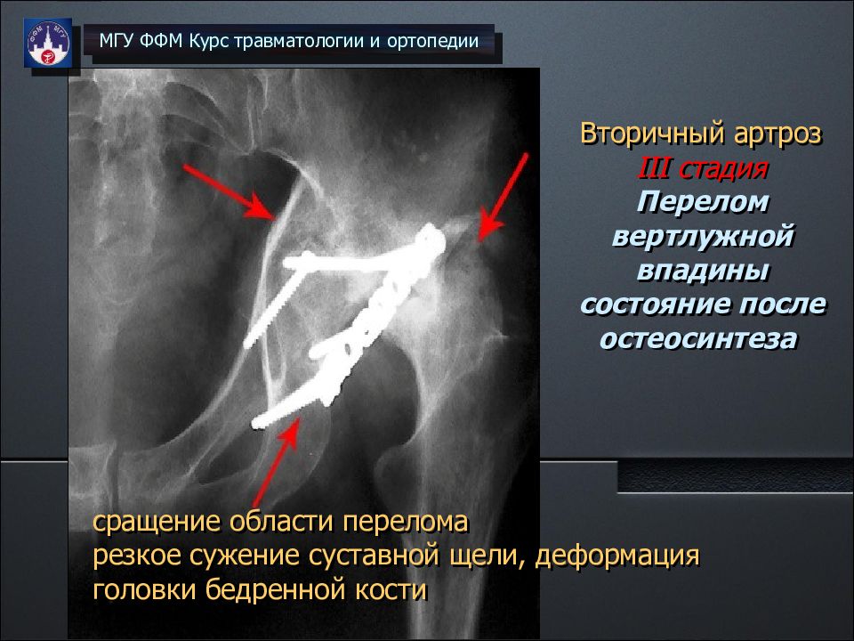 Некроз костей 3 степени. Асептический некроз вертлужной впадины рентген. Асептический некроз вертлужной впадины тазобедренного сустава. Переломы вертлужной впадины травматология. Идиопатический асептический некроз кости.