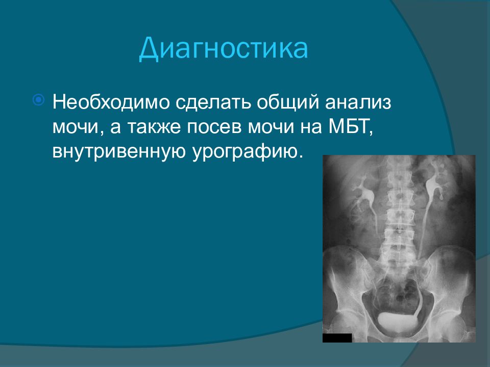 Туберкулез мочевыделительной системы презентация