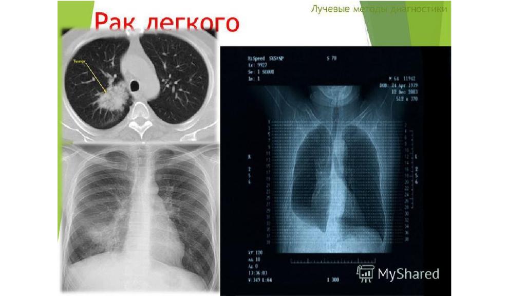 Рак легкого диагностика презентация