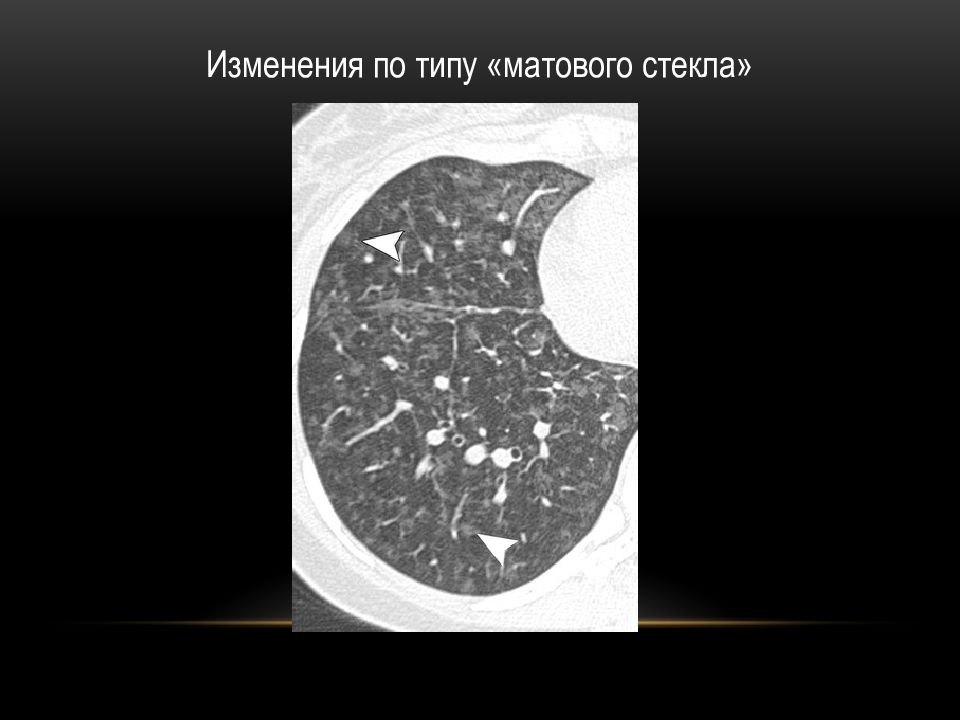 Легочное по типу матового стекла. Изменения по типу матового стекла. Очаги по типу матового стекла. Очаги матового стекла в легких на кт. По типу матового стекла.