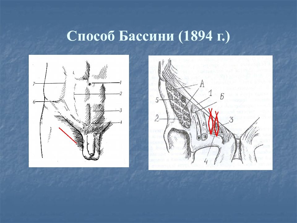 Бедренный способ при бедренной грыже. Герниопластика по Бассини. Грыжесечение по Бассини.