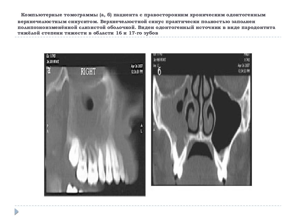 Одонтогенный верхнечелюстной синусит презентация