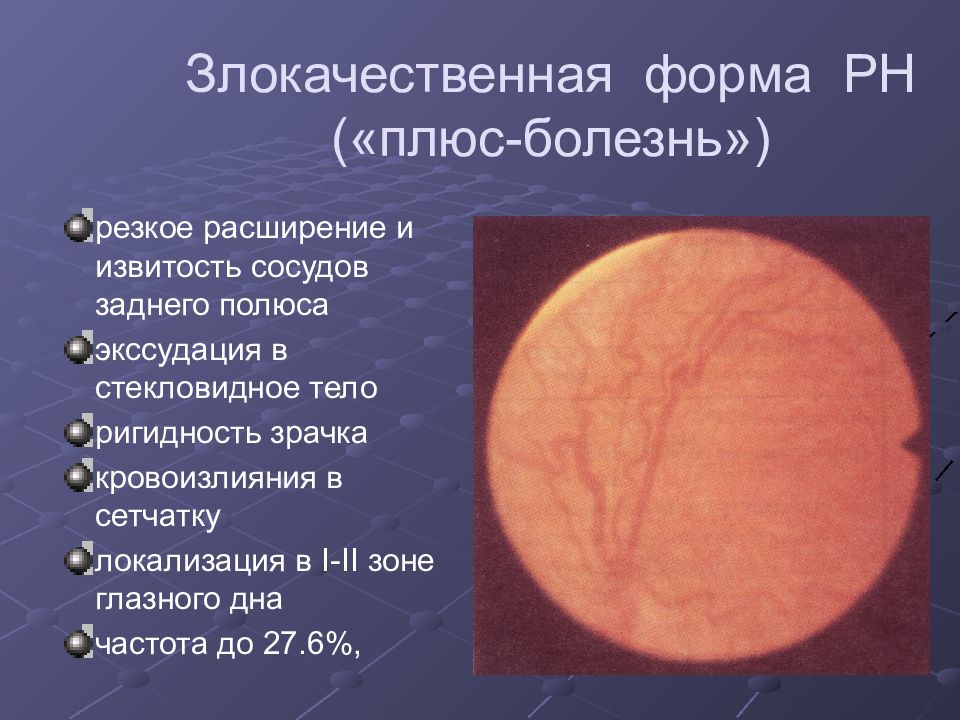 Ретинопатия недоношенных презентация