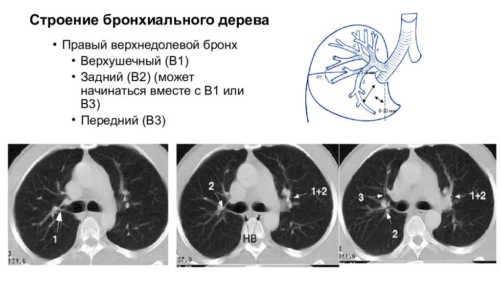 Кт бронхов. Анатомия бронхов на кт. Анатомия бронхиального дерева на кт. Строение бронхиального дерева кт. Бронхиальное дерево на кт.