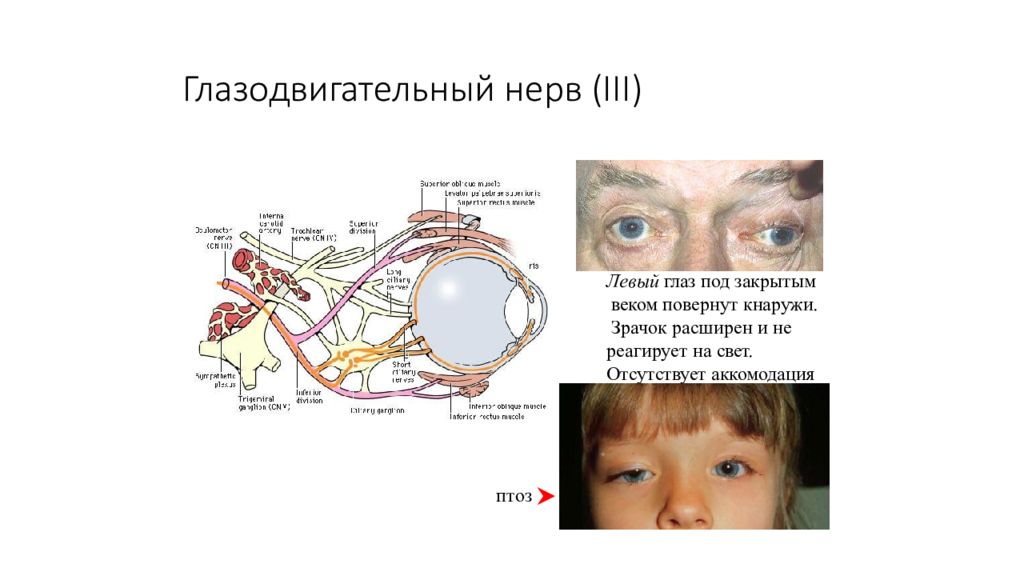 Глазодвигательный нерв находится. Симптомы поражения глазодвигательных нервов (III, IV, vi).. 3 Пара глазодвигательный нерв схема. Поражение глазодвигательного нерва неврология. Глазодвигательный блоковый и отводящий нервы схема.