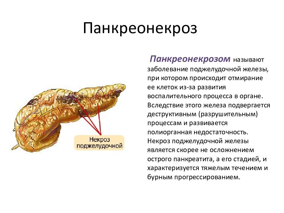 Поджелудочная имбирь. Жировой панкреонекроз поджелудочной железы. Панкреонекроз патологическая анатомия. Острый панкреатит поджелудочной железы. Острый панкреатит панкреонекроз.