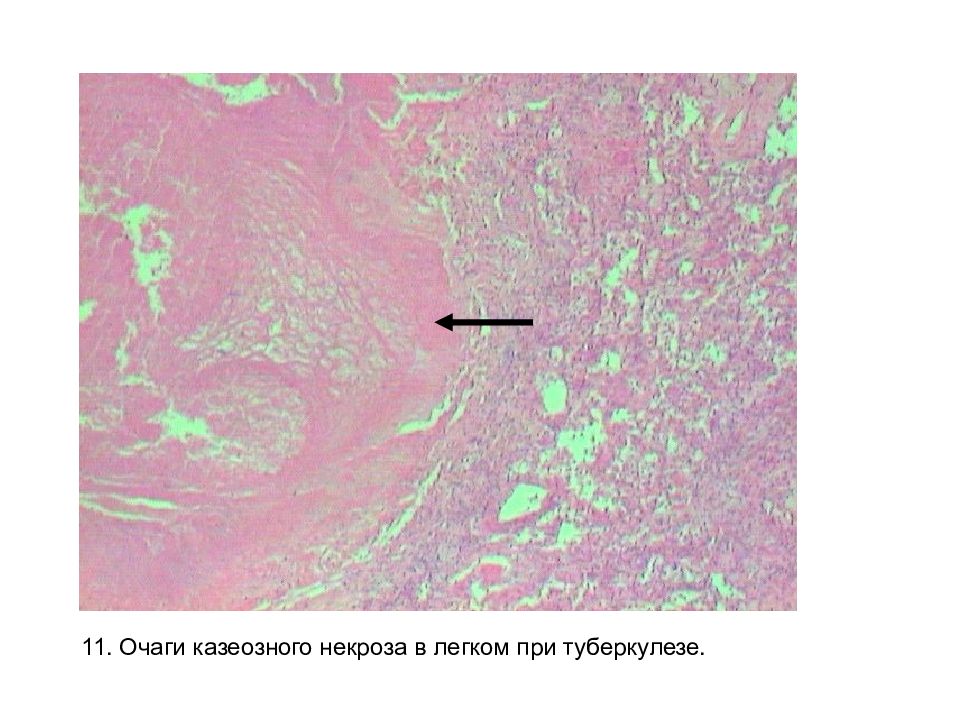 Туберкулезная гранулема рисунок