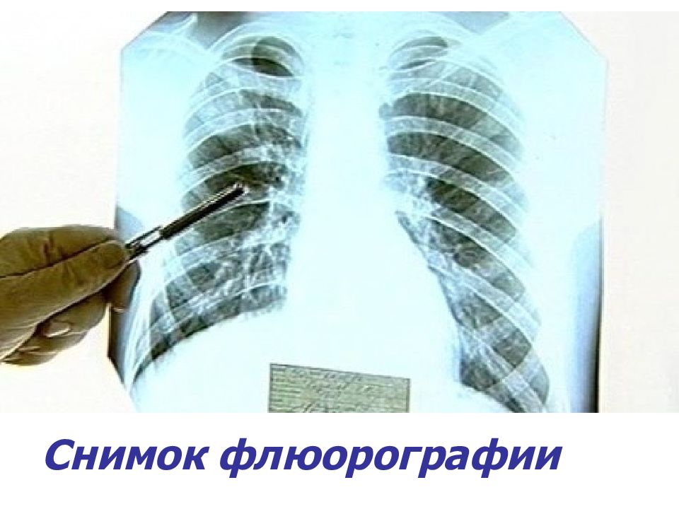 После рентгена можно делать флюорографию. Флюорография. Флюорографического исследования грудной клетки человека.