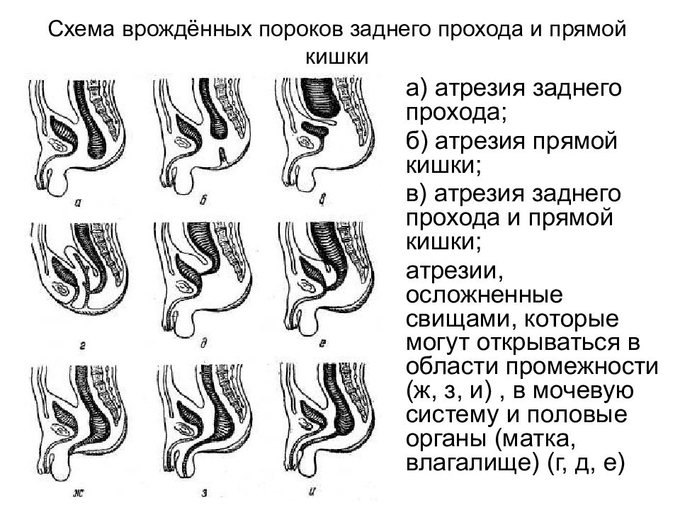 Презентация операции на прямой кишке