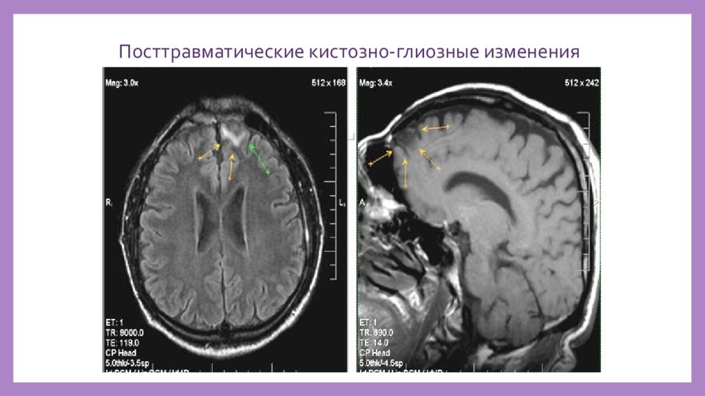 Кистозно атрофические изменения головного. Кистозно-глиозные изменения головного мозга кт. Кистозно-глиозная трансформация головного мозга на кт. Глиозные изменения головного мозга на кт. Кистозно-глиозная трансформация головного мозга что это такое.
