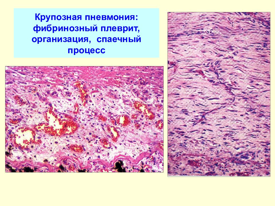 Сухая пневмония. Фибринозно Гнойный плеврит. Фибринозная крупозная пневмония. Фибринозная пневмония макро. Фибринозная пневмония макропрепарат.