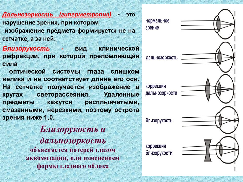 Что такое гиперметропия. Гиперметропия это в физиологии. Степени миопии и гиперметропии. Коррекция гиперметропии. Аккомодация гиперметропия.