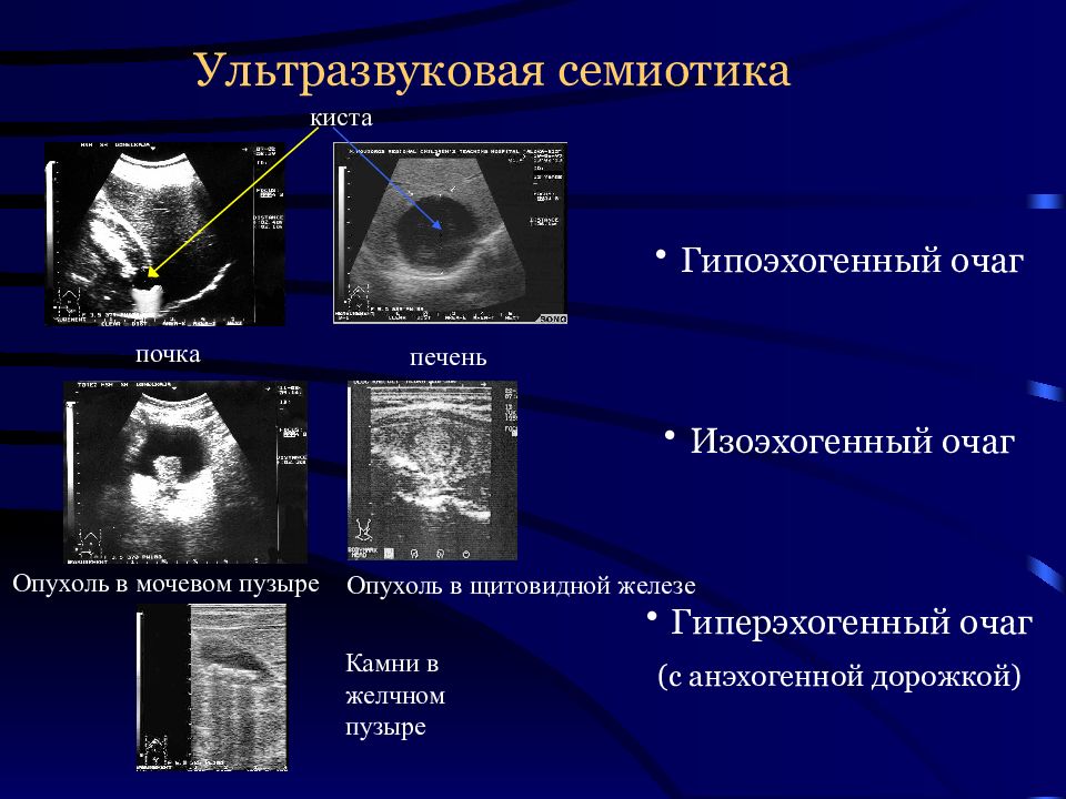 Что такое изоэхогенное образование. Изоэхогенные образования в почке. Радионуклидная ангиокардиография.