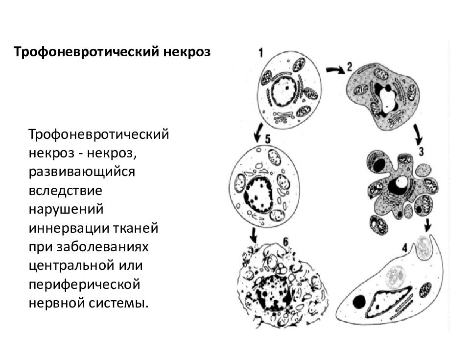 Как развивается некроз. Трофоневротический некроз. Некроз отмирание тканей. Некроз радиобиология схема.