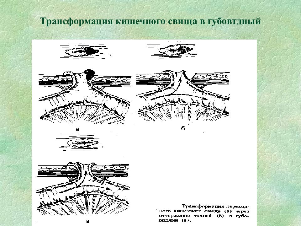 Лечение кишечных свищей