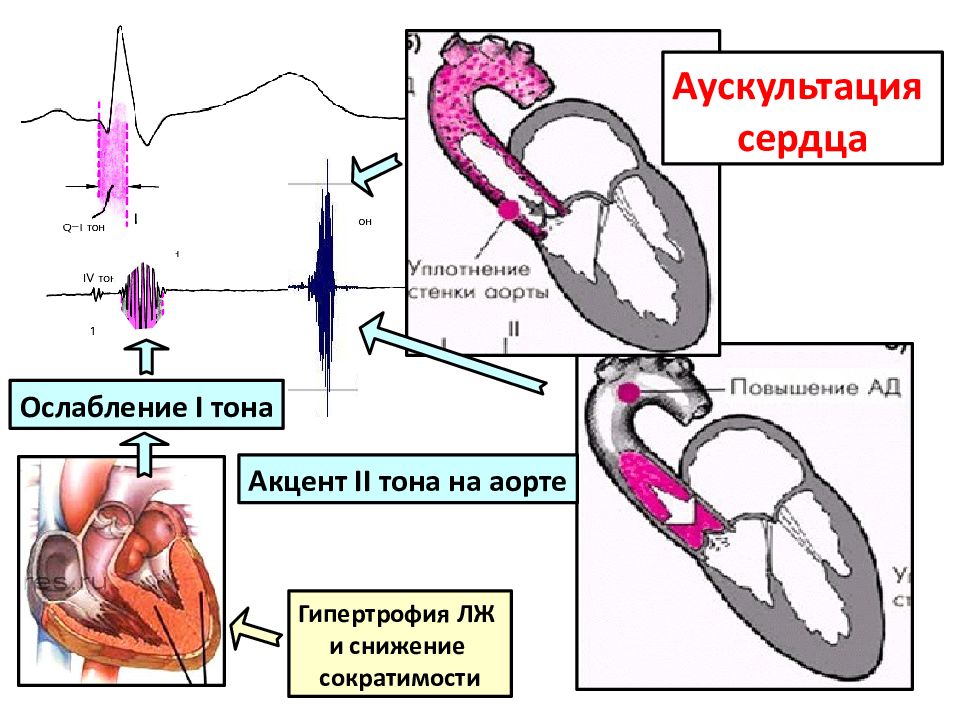 Ослабленные тоны сердца