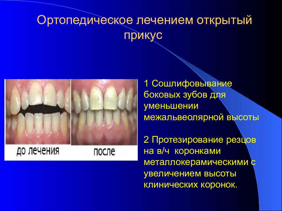 Открытый прикус